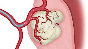 uterin arter embolizasyonu