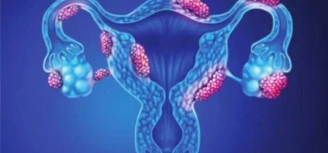 üreme sistemi iltihaplanması tedavi ücretleri